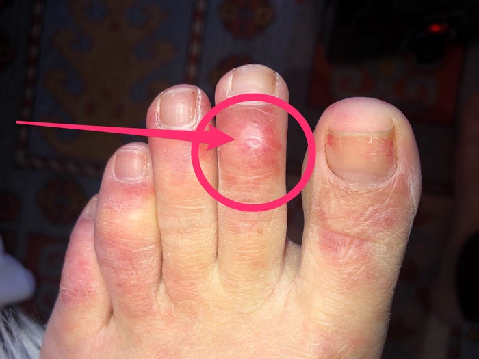 An example of COVID Toes